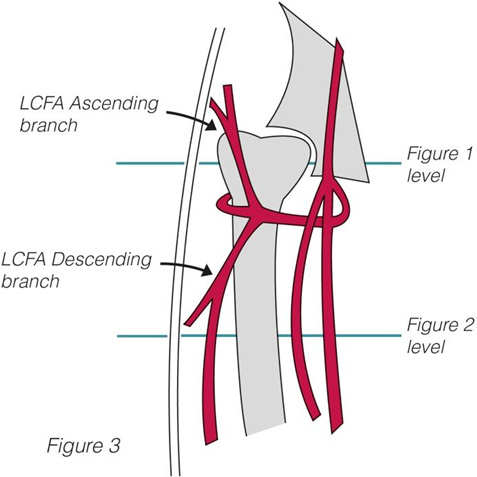 Levels of operative approach for hip arthroplasty and anterolateral thigh flap in relation to the ascending and descending branch of the LCFA.