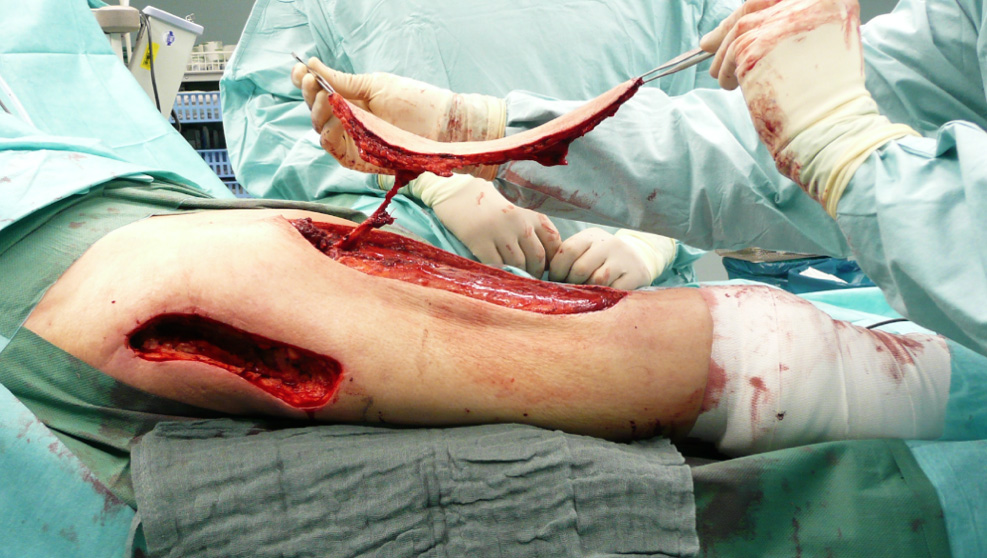 Proximal located vascular pedicle after flap harvesting.