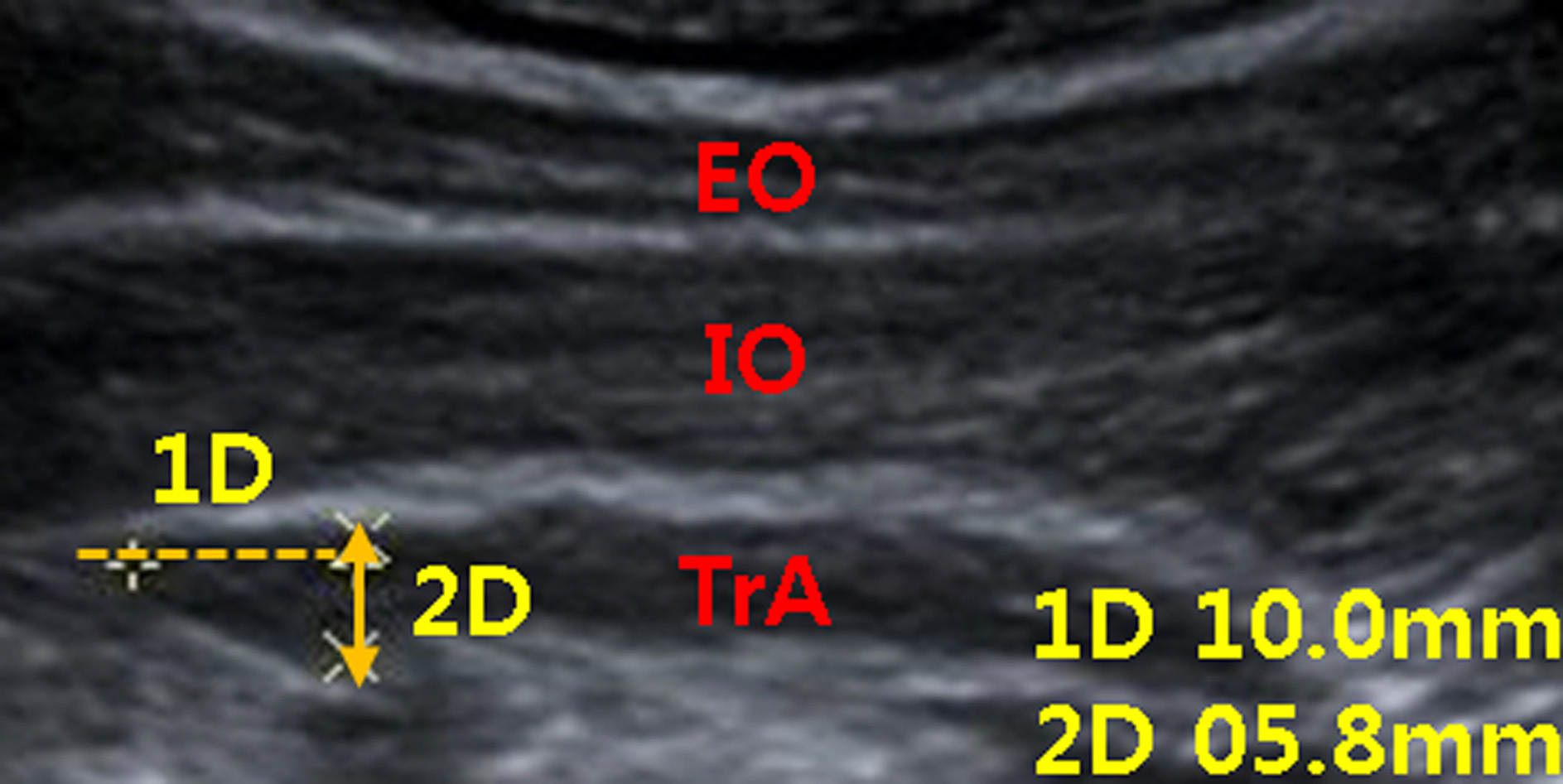 Ultrasound muscle thickness data of the TrA muscle. TrA: transversus abdominis; IO: internal oblique; EO: exter-nal oblique.