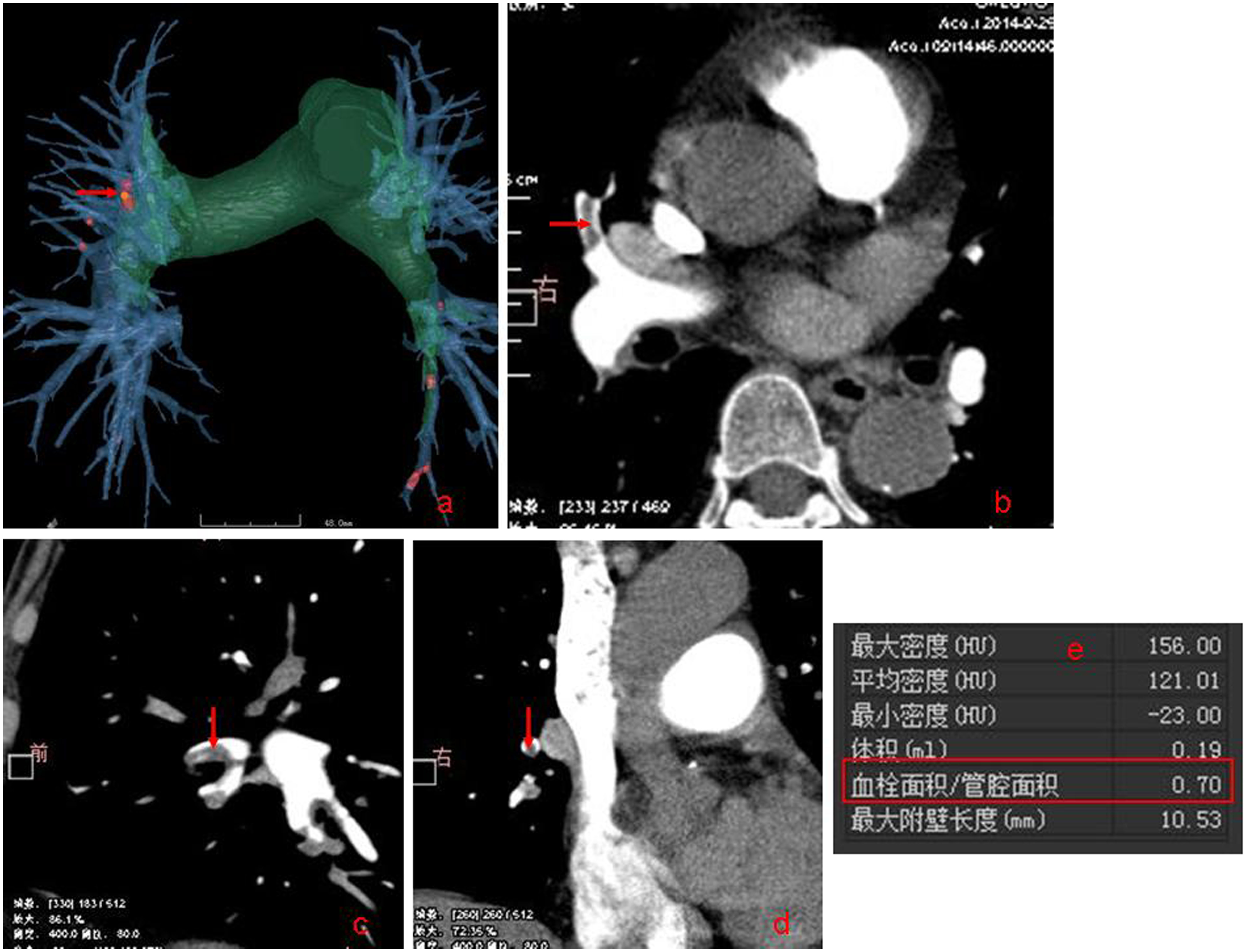 Fully automatic identified pulmonary embolism and automatic calculated embolism area/ lumen area (red box).
