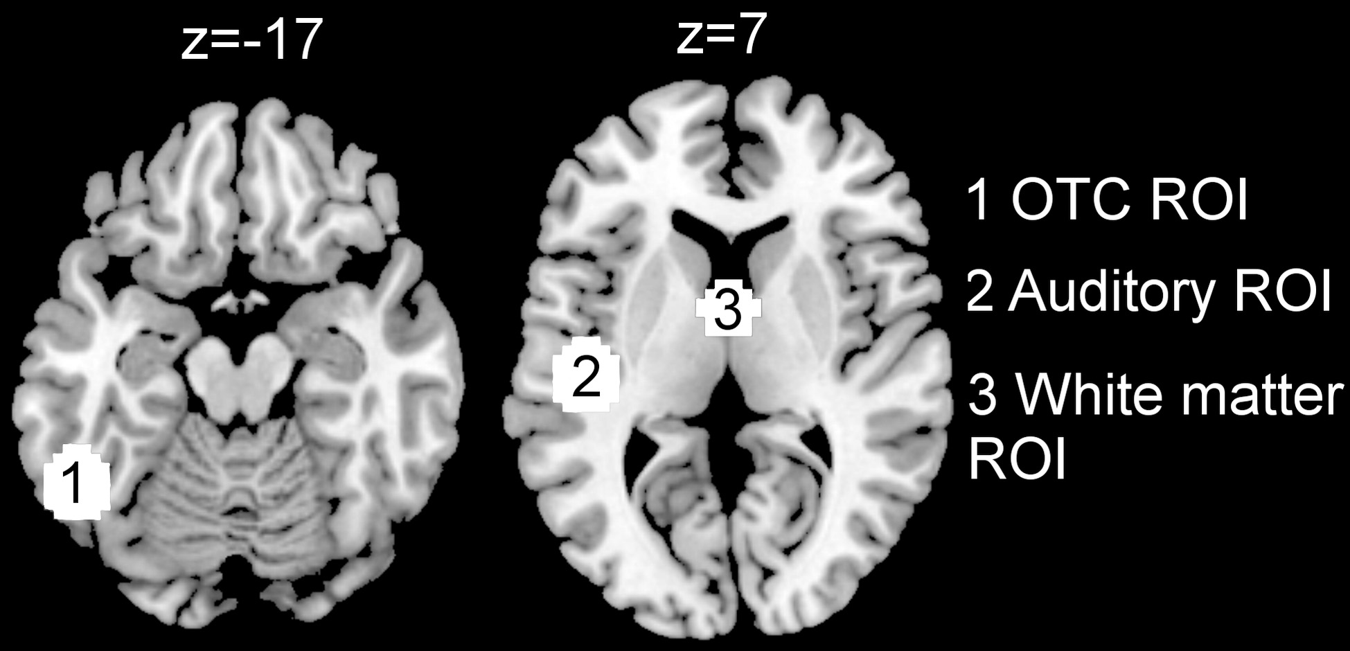 Regions of interest (ROI). ROIs are 12 mm-spheres centered at (-52, -53, -17) for the OTC ROI, (-45, -21, 7) for the Auditory ROI and (0, 0, 0) for the White matter ROI. Coordinates on the z-axis of the MNI space are provided above the corresponding horizontal brain sections. OTC: occipital-temporal cortex.