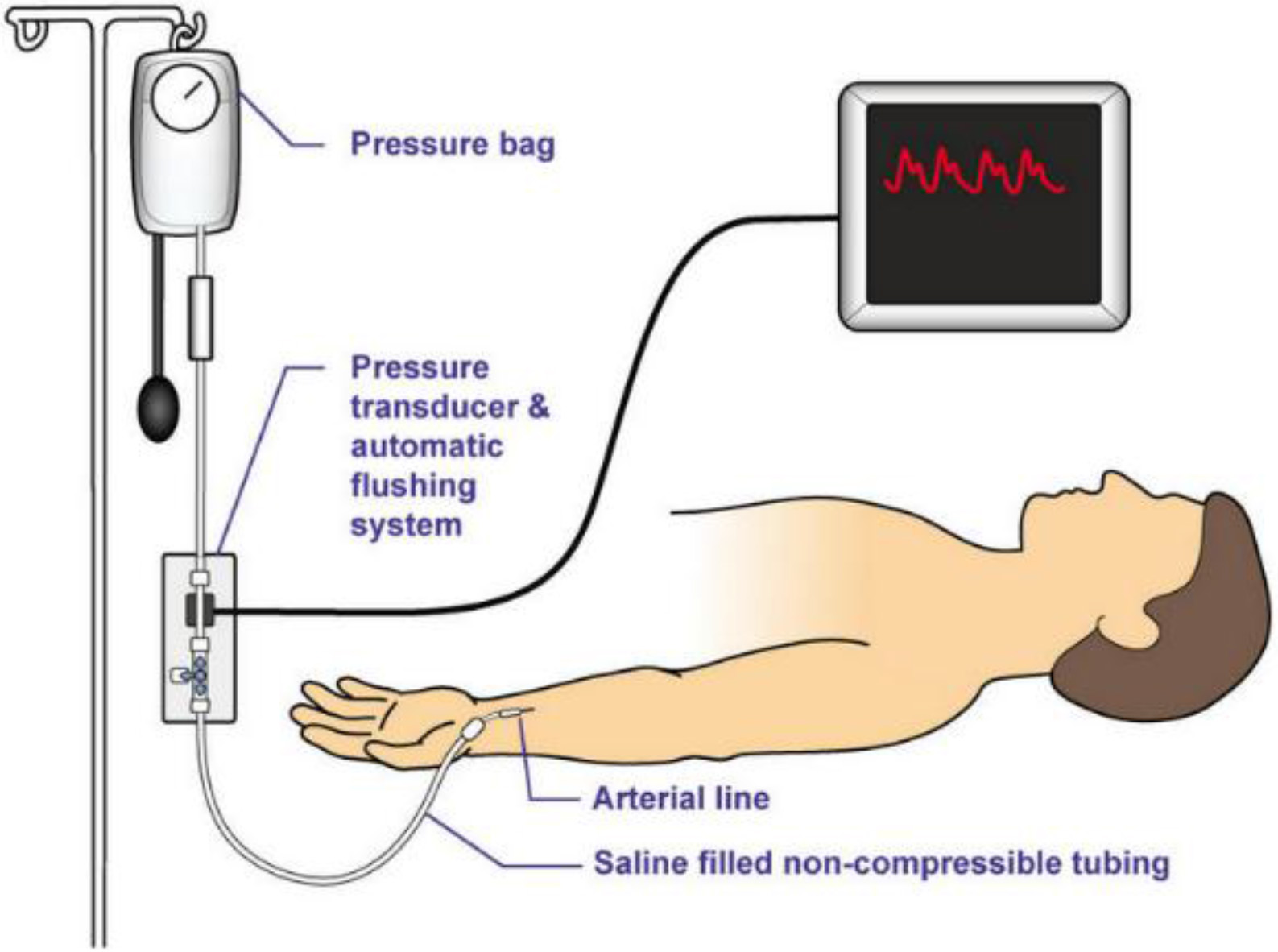 Components of an arterial monitoring system [6, 7].