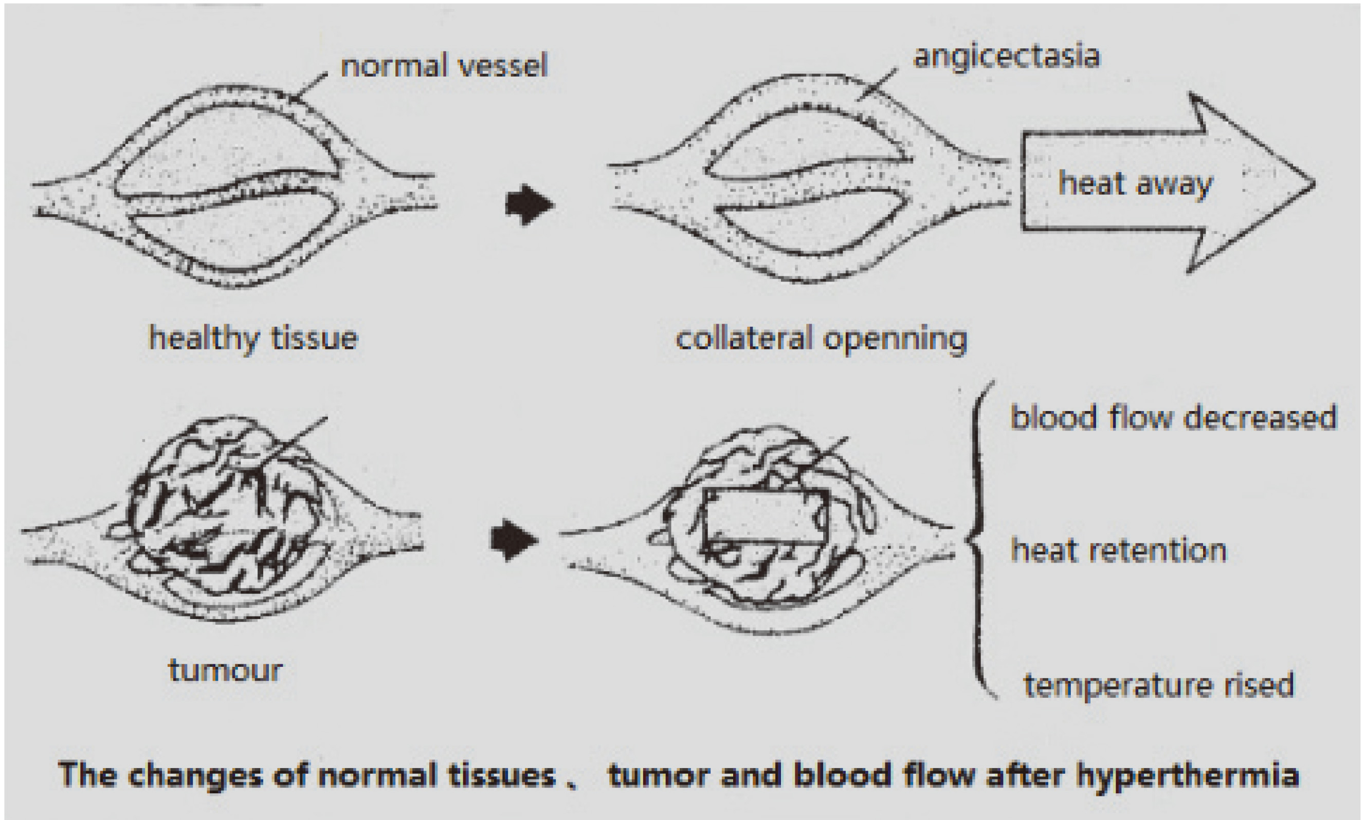 Schematic diagram of tumor and healthy tissue after ultrasonic hyperthermia.