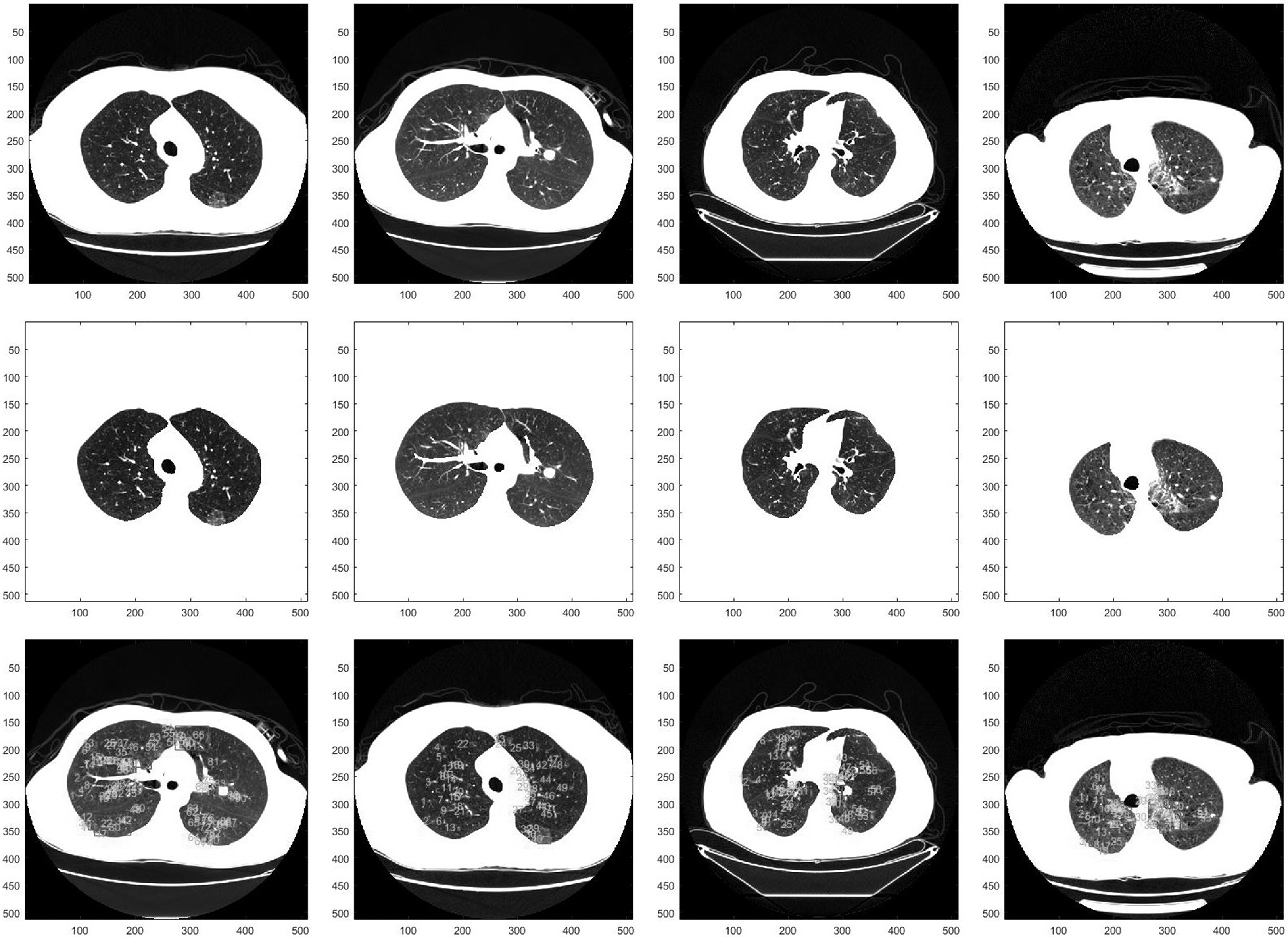 The results of the lung region segmentation and the candidates extraction: the rows from top to bottom are the original images, the segmented lung regions and the suspected nodular lesion respectively.
