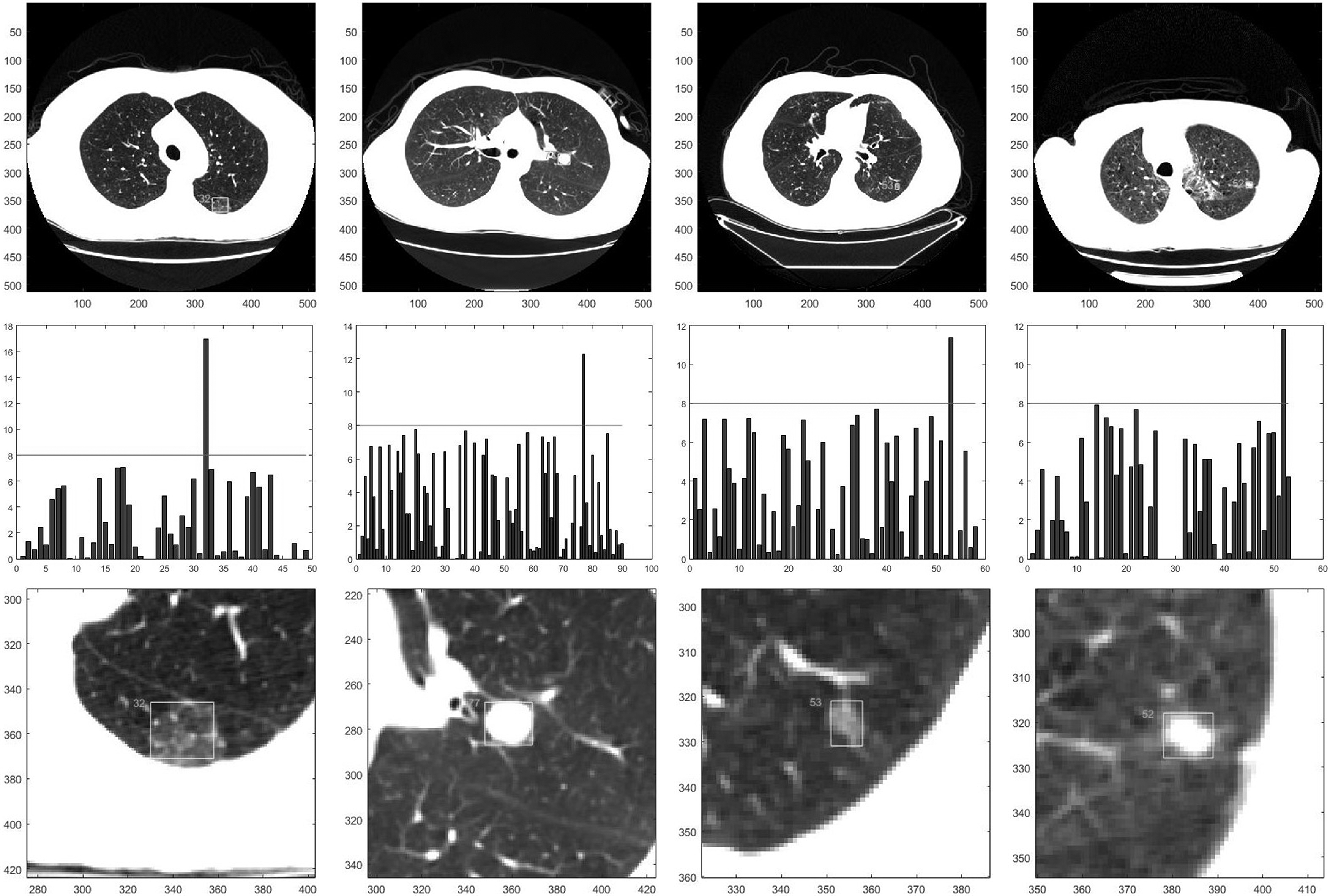 The lung cancer diagnosis result: the rows from top to bottom are the original images, the depth of the fuzzy regions of the images and the recommended regions respectively.