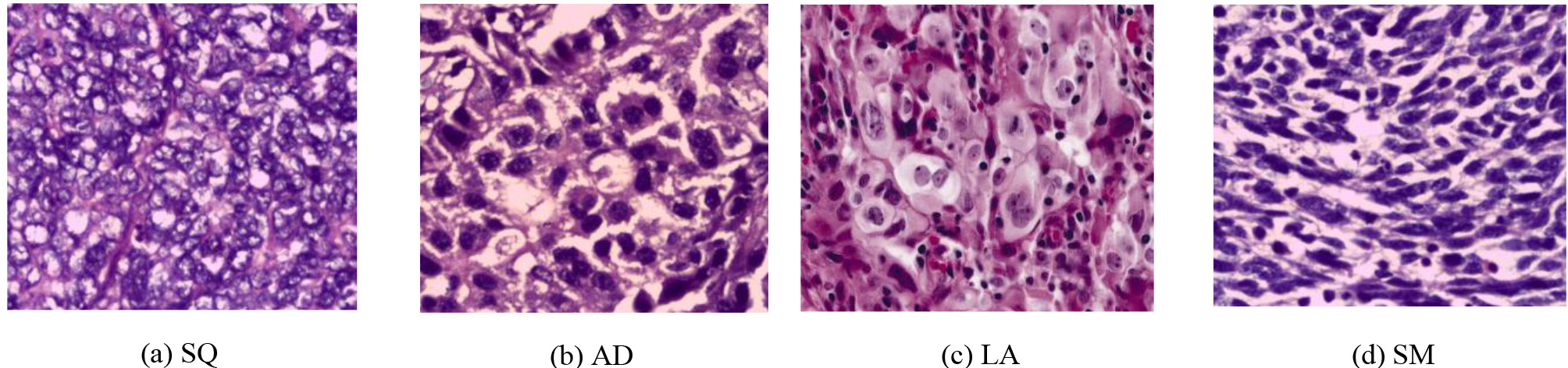 Pathological section of four types of typical lung cancer tissues (he, 50x).
