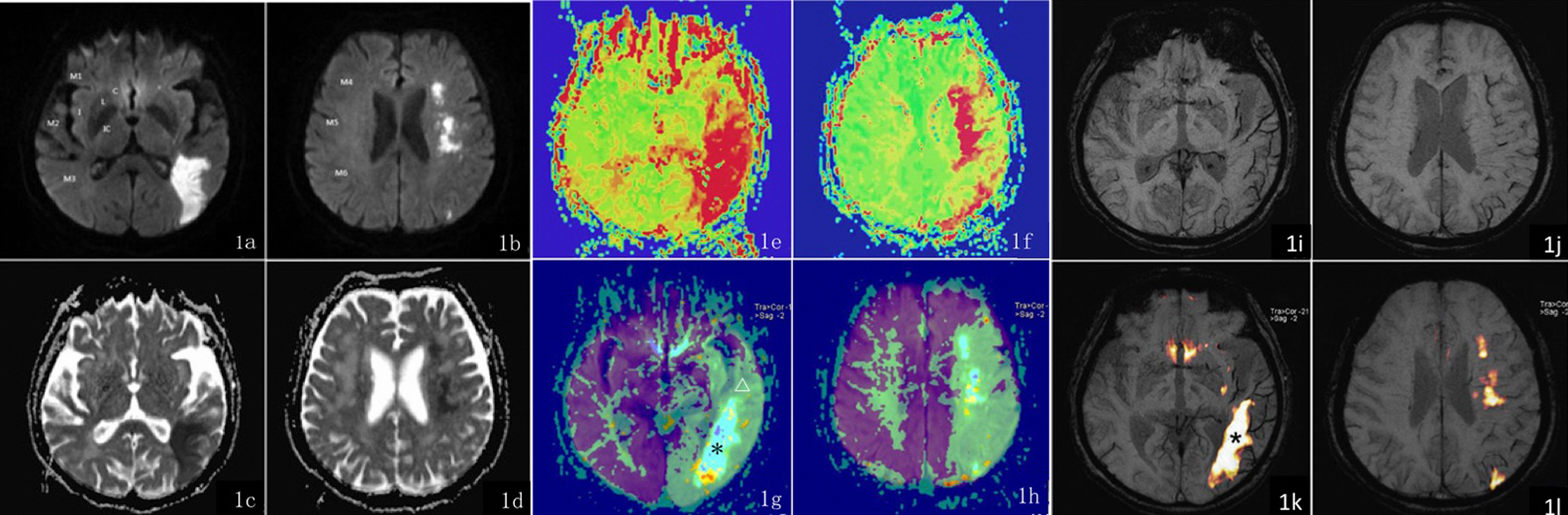 A female patient, 76 years old, complains of left-sided numbness on when she tries to stand quickly and aphasia over the past 15 hours. Figures 1a and 1c show a patchy hyperintensity on SWI in a single cortical area (Section M3) served by the left middle cerebral artery (area M3). The ADC image shows a reduced ADC value in the left occipital lobe. Figures 1b and 1d show a patchy hyperintensity on SWI in 3 areas served by the left middle cerebral artery (Sections M4-M6) and a decreased ADC signal: ASPECTS = 6 scores. Figures 1e and 1f present a perfusion image (MTT map) with the MTT extending into the left insula and all 6 areas served by the left middle cerebral artery (Sections M1-M6): ASPECTS = 3 scores. Figures 1g and 1h show superimposed DWI and MTT images. Δ indicates an area with an abnormal perfusion signal area; * indicates an area of hyperintensity detected by DWI. The area of abnormal perfusion is clearly larger than the abnormal DWI area in the superposed image. Figures 1i and 1j show a greater number of enlarged small veins in the left insula and in all 6 cortical areas served by the left middle cerebral artery (Sections M1-M6) than are seen on the other side in the SWI minIP image: ASPECTS = 3 scores. Figures 1k and 1l show superposed DWI and minIP images. * indicates an area of DWI-detected hyperintensity. The area containing an increased number of small veins is larger on SWI compared with the abnormal area shown on the DWI. Key: C, caudate nucleus; L, lenticular nucleus; IC, internal capsule; middle cerebral artery cortical areas (Sections M1-M6); I, insula.