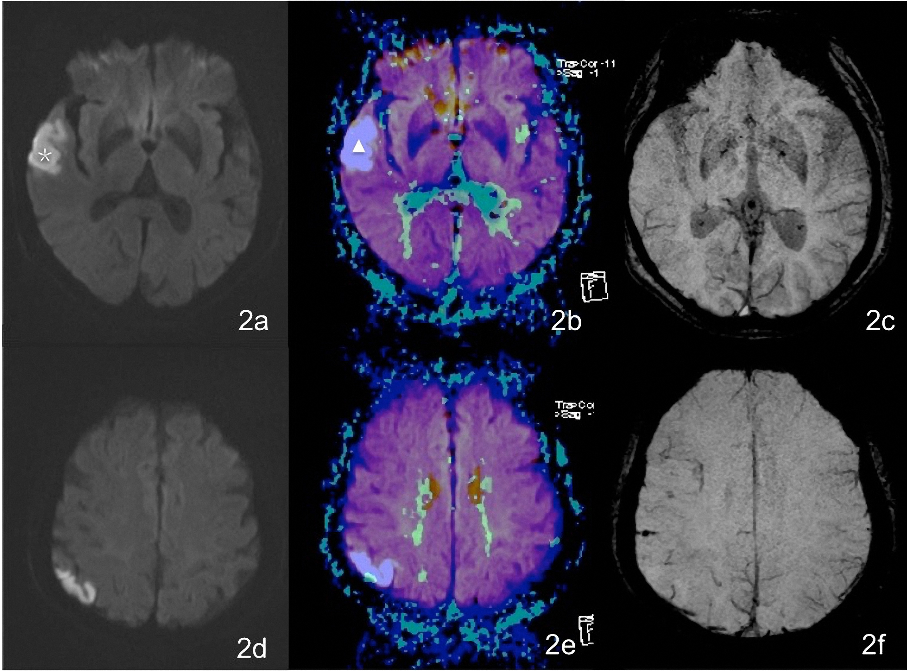 A female patient aged 76 years complains of vague speech for 46 hours. Figures 2a and 2d show patchy hyperintensity on a DWI of the right temporal lobe and occipital lobe. In Figs 2b and 2e, the white Δ indicates an area with an abnormal MTT signal within an area detected by a DWI superimposed on it. In Figs 2c and 2f, the black  indicates an area of DWI-detected hyperintensity with no increase in the number of small veins seen on superposed images of the SWI minIP and DWI. 