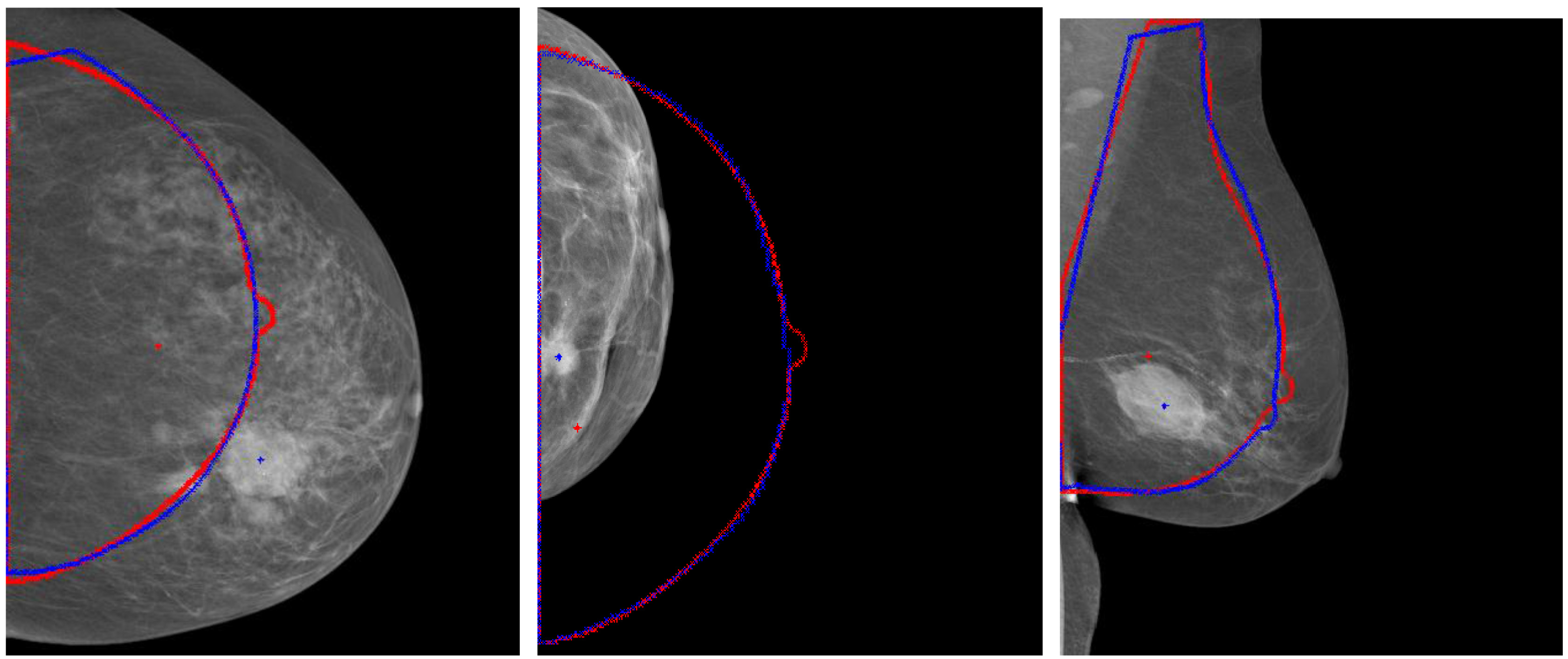 Results for aligning the large, small and pendulous breast with the standard breast.