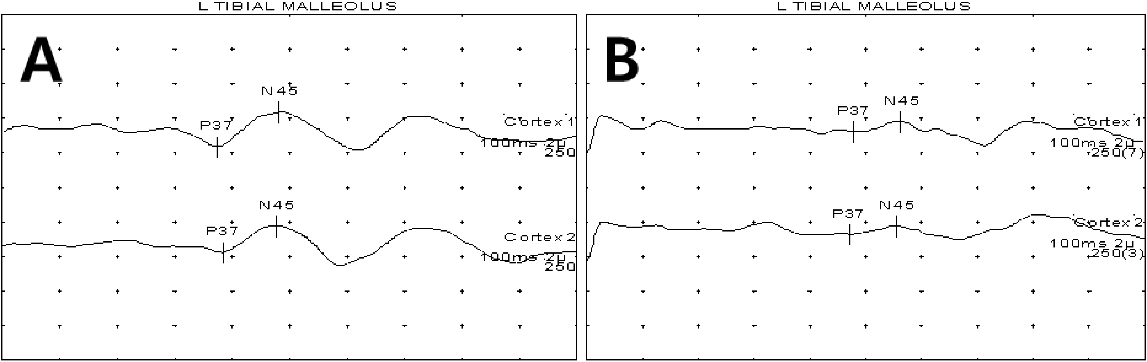 Examples of SSEP graphs for patients with normal (A) and abnormal SSEPs (B). SSEP data were classified into (A) a normal sensory group (normal latency; P37 < 41.7 ms) and (B) an abnormal sensory group (delayed latency; P37 ⩾ 41.7 ms). SSEP: somatosensory-evoked potential. 