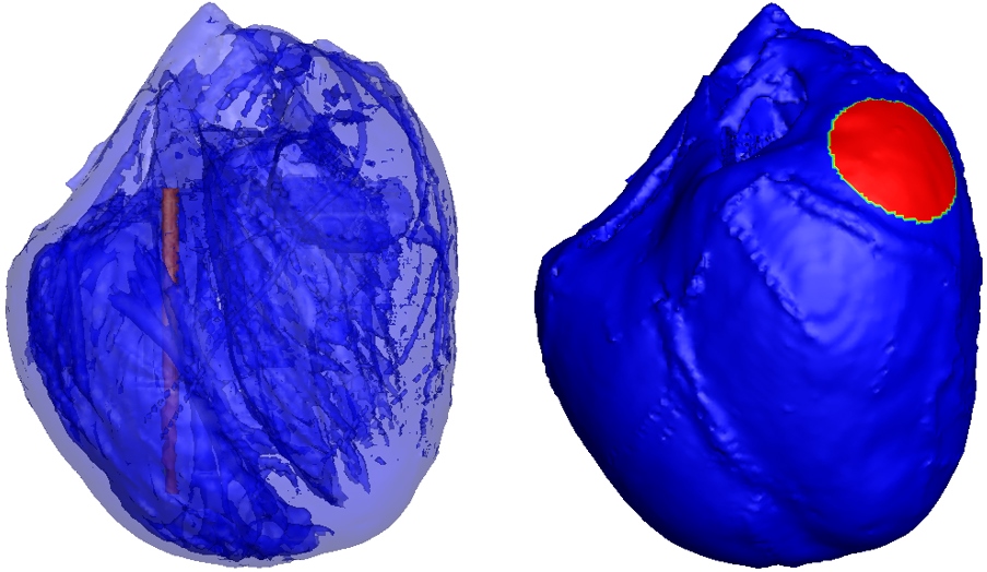 ICD electrode configuration was used in the simulation. The red part of in the right ventricle as shown in left picture is the columnar electrode, the red part of on left ventricular epicardium as shown in right picture is the circular patch electrodes.