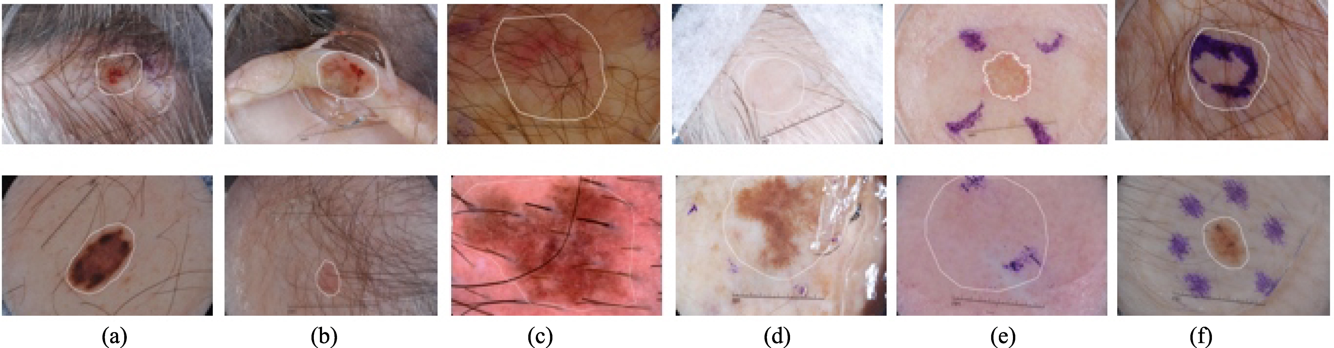 Illustration of challenges of automatic segmentation of skin lesions in dermoscopy images. The main challenge includes distinguishable inter-class, indistinguishable intra-class variations, artifacts and inherent cutaneous features in natural images. (a–c) skin lesions are covered with hairs or exploded with blood vessels; (d) air bubbles and marks occlude the skin lesions; (e–f) dye concentration downgrades the segmentation accuracy. Note that white contours indicate the skin lesions.
