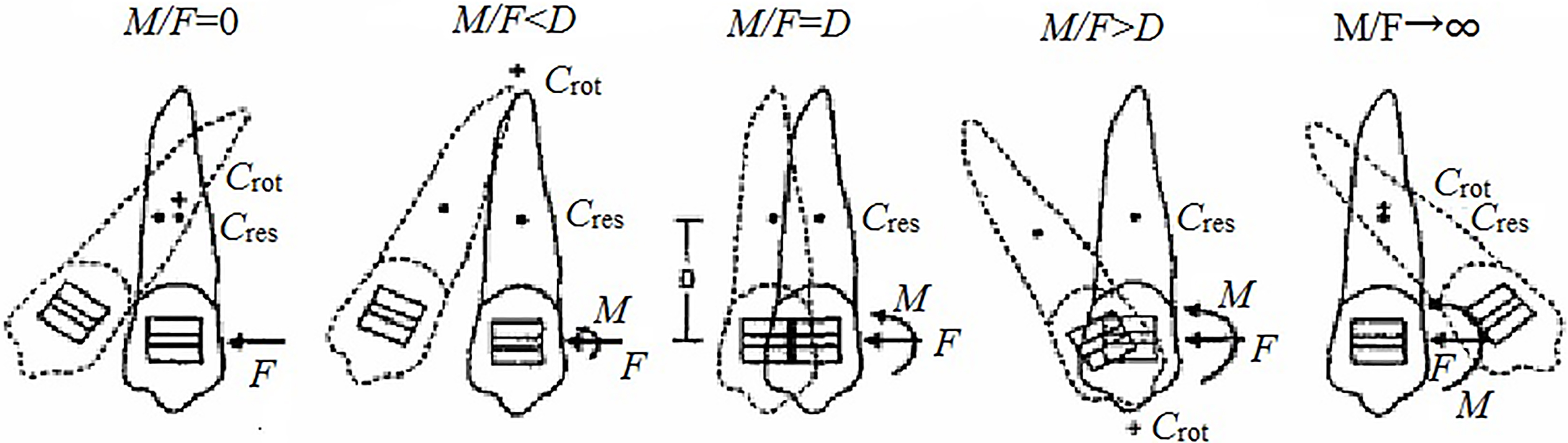 Relationships between tooth movements and orthodontic force systems.