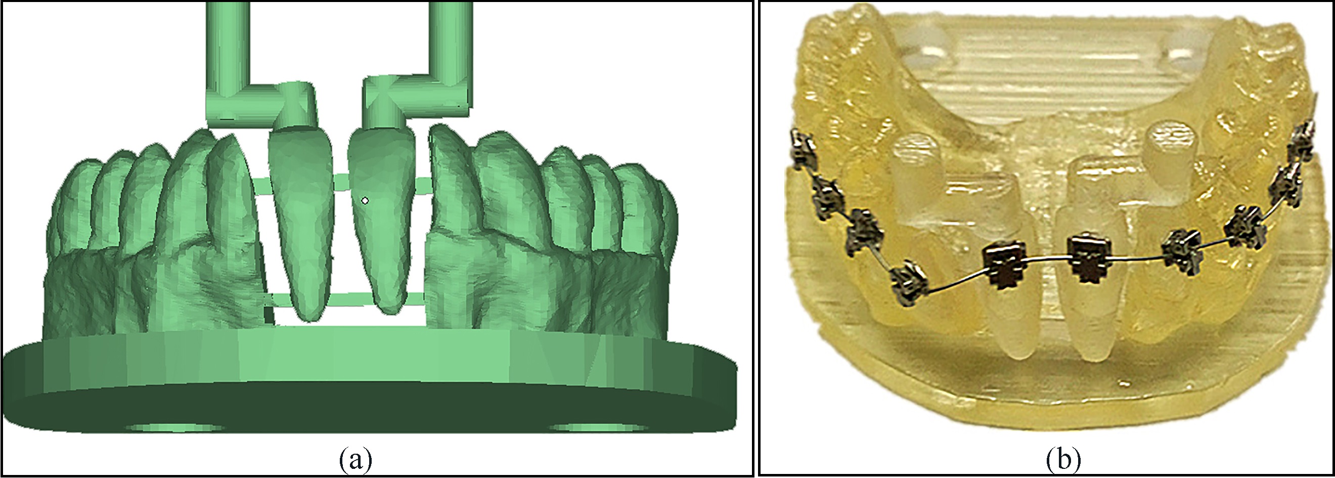Simulated dental model, (a) digital model; (b) physical model assembled with brackets and archwire.