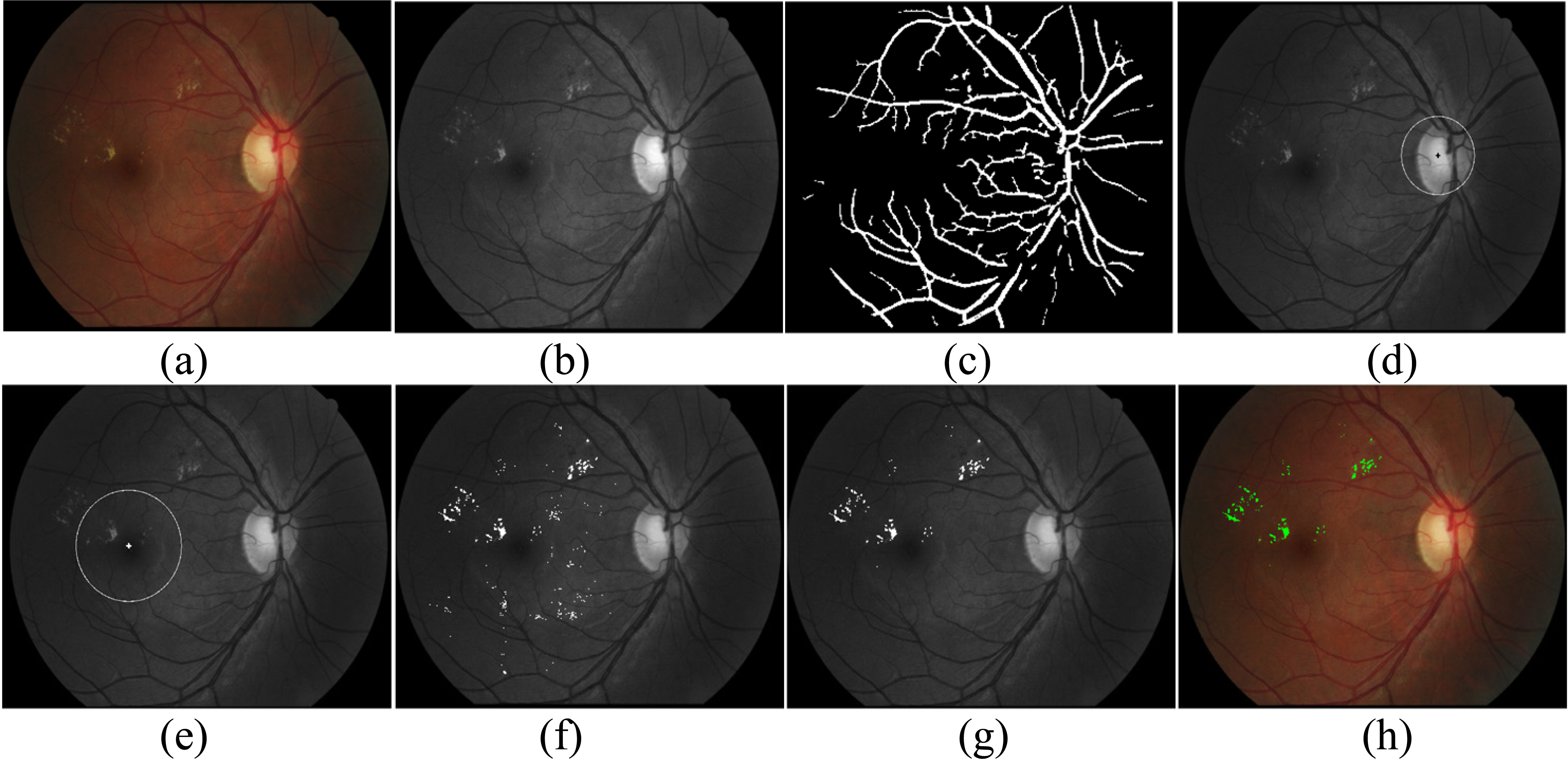 An example of the proposed procedure. (a) Original image, (b) the green channel image, (c) outputs of main vessel segmentation, (d) OD localization and defection, (e) macula localization and coordinates, (f) outputs of exudate candidates, (g) outputs of exudate classification, (h) the final outputs of exudate in RGB image.