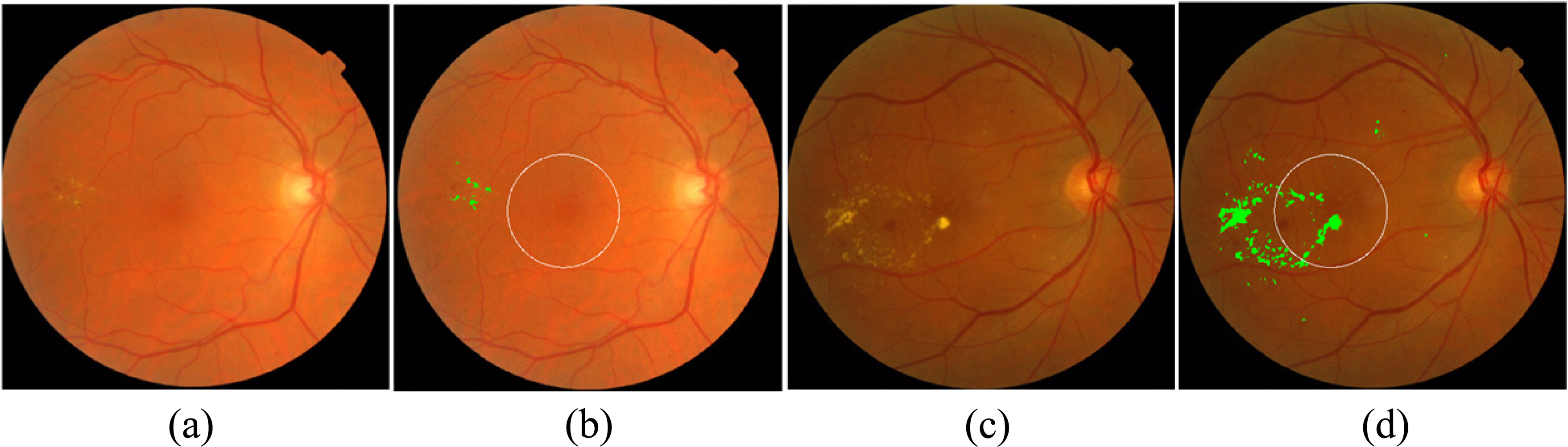 Examples of macular edema detection for MESSIDOR database. (a) and (b): Original and result of exudate detection and macular coordinates images of a non-CSME example, (c) and (d): Original and result of exudate detection and macular coordinates images of a CSME example, the detected exudates are labelled in green.