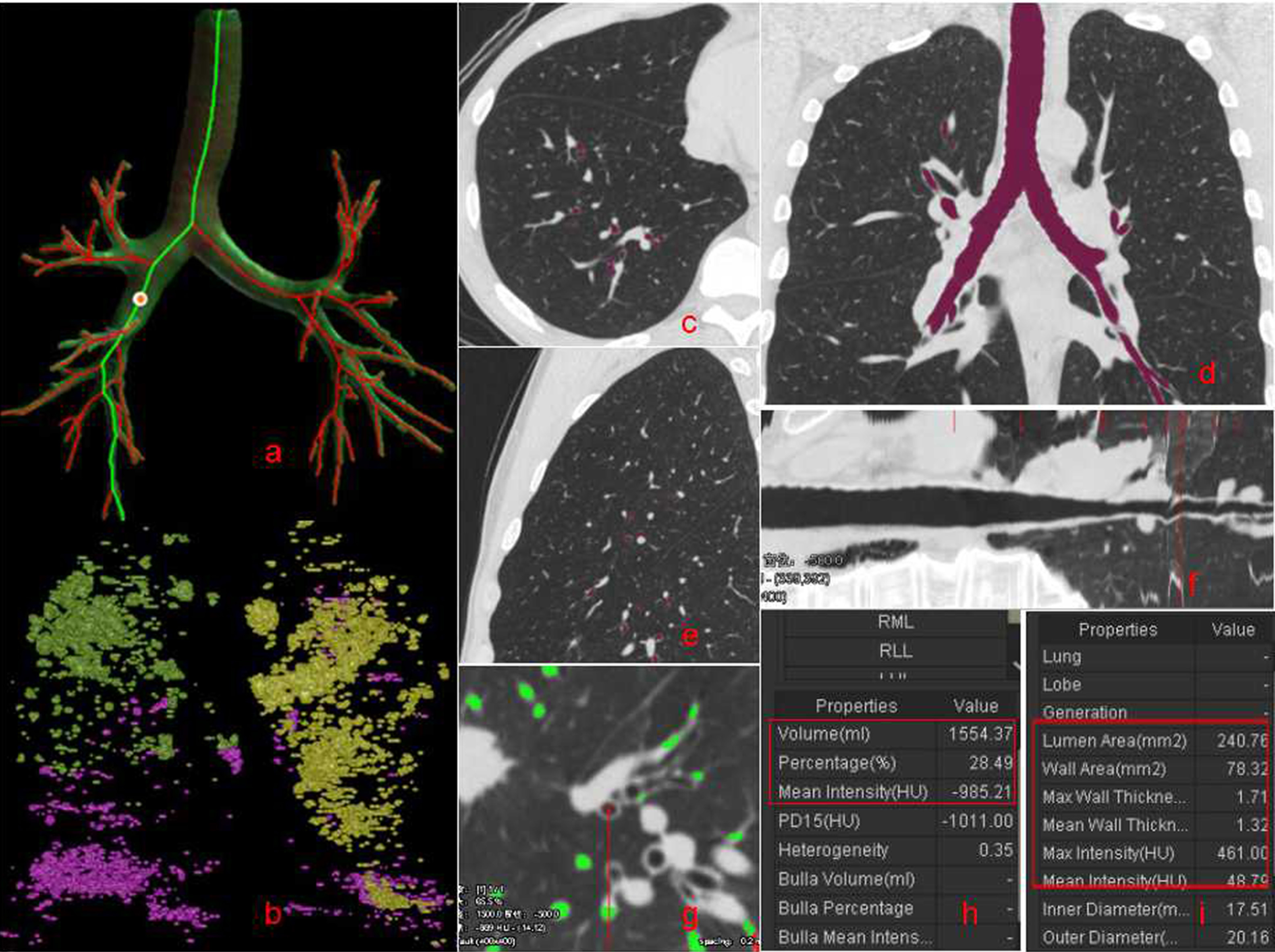 The following steps of CT quantitative analysis of measurement parameters: a depict the bronchial auto-segmentation diagram; b depit the range of %LAA-950; c, d, and e are the axial, coronal, and sagittal images respectively; f is bronchial straightening; g depicts the bronchial in the visual field; h and i show measurement parameters.