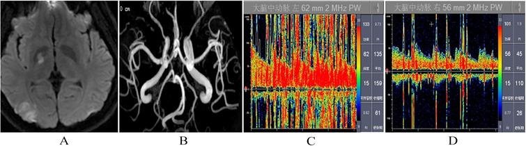 The main observation results in patient case 1: (A) MRI of the right basal ganglia and right occipital lobe. (B) Magnetic resonance angiography (MRA) of neck and intracranial arteries. (C) c-TCD test in the fourth cardiac cycle after Valsalva action. (D) TEE examination.