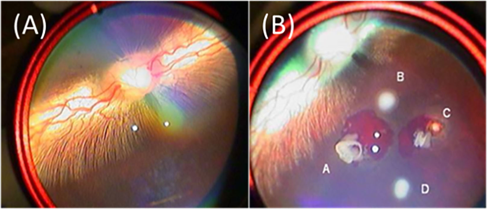 Fundus images of the Rex rabbit: (A) before laser photocoagulation and (B) after laser photocoagulation. Four spots were created by laser light.