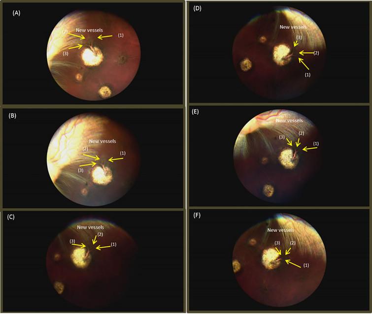 Fundus images: (A) 28th day after retinal laser photocoagulation, (B) 7th day after intravitreal injections, (C) 7th day after intravitreal injections, (D) 14th day after intravitreal Injections, (E) 21th day after intravitreal Injections, and (F) 28th day after intravitreal injections.