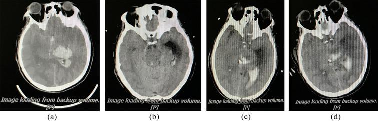 Relationship between CT and MIPS in patient with cerebral hemorrhage. (a) Preoperative; (b) Postoperative, MIPS declines 3.51∘ and ICP is 9.26 mmHg, edema and hydrocephalus; (c) After surgery 3 days, MIPS declines 4.05∘ and ICP is 9.04 mmHg, severe cerebral edema; (d) After surgery 7 days, with increased hemorrhage, hydrocephalus, MIPS declines 1.91∘ and ICP is 27 mmHg.