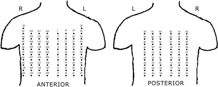 Electrodes distribution of BSPM system. Four regions: I-anterior left region, II-anterior right region, III-posterior left region, IV-posterior right region.
