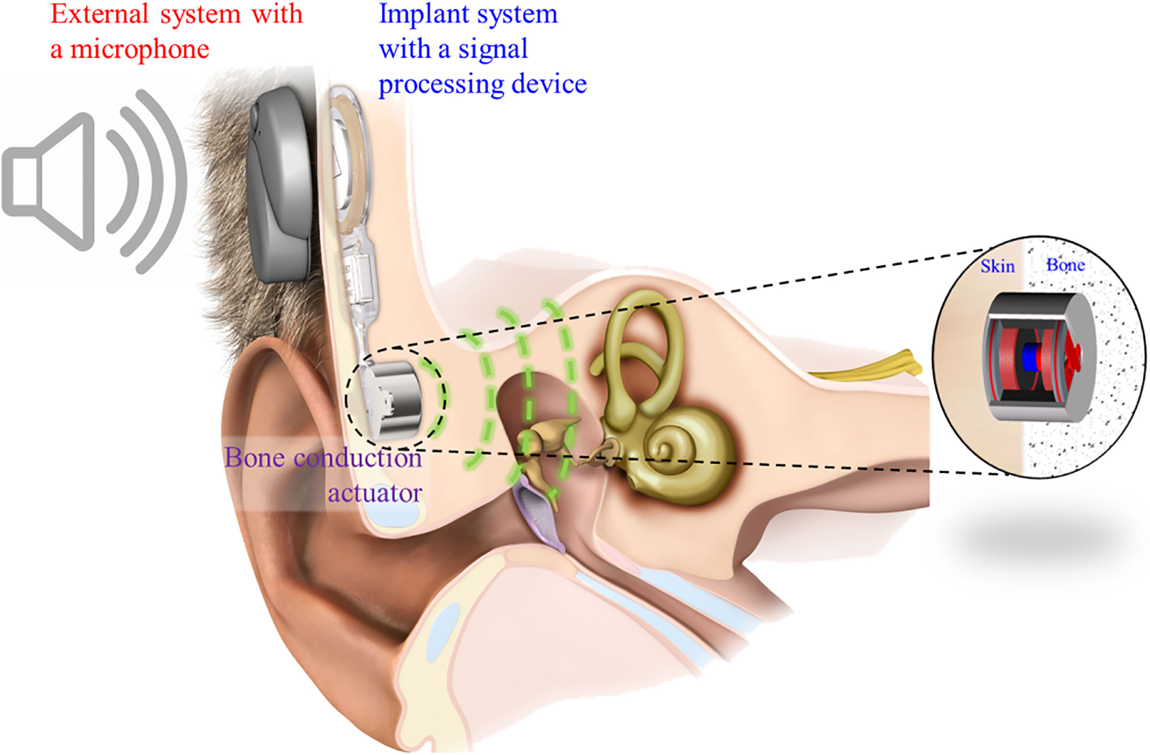 The components of the implantable bone conduction hearing aid [15].