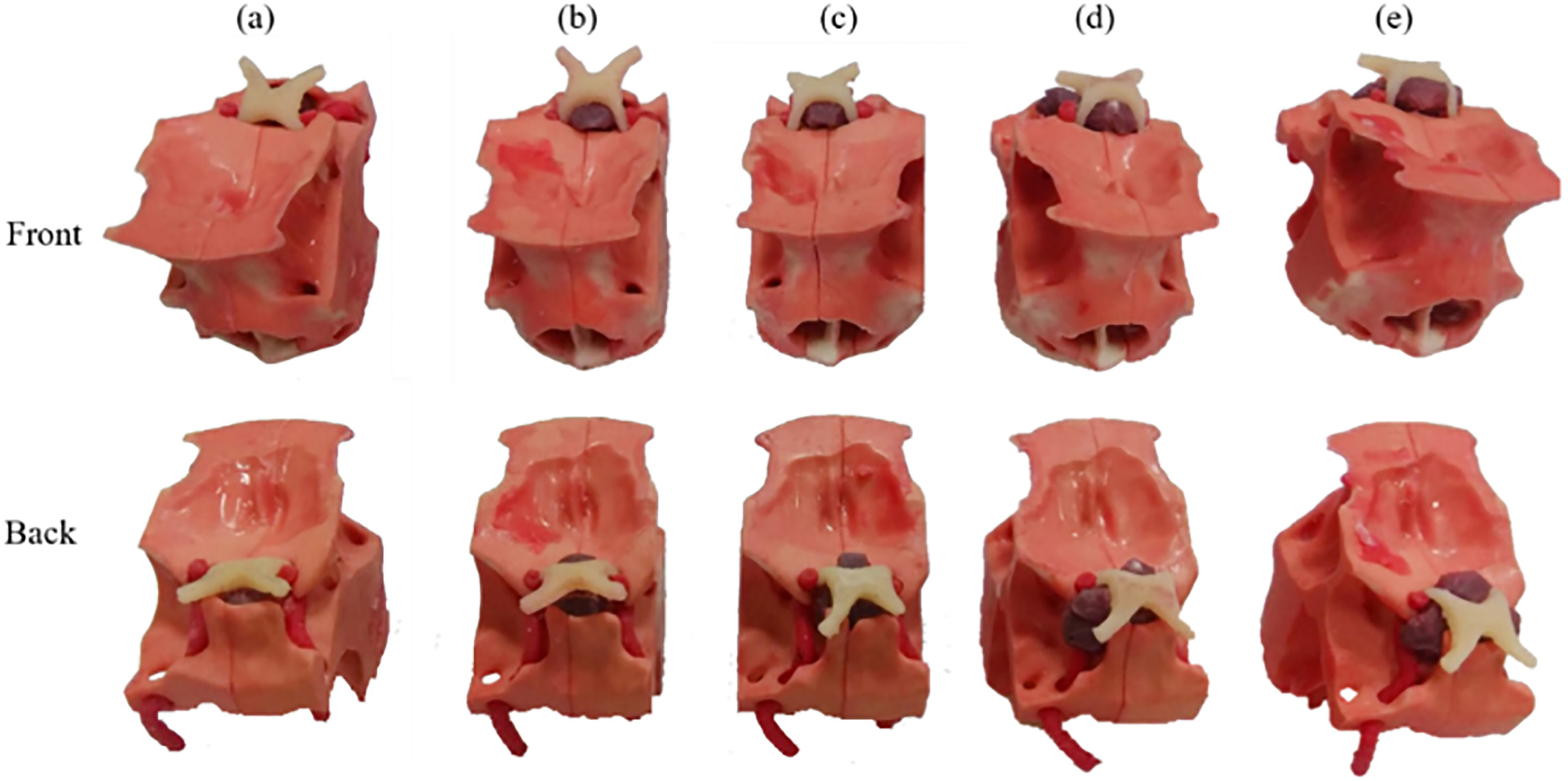 Surgical area models with different levels of tumors.
