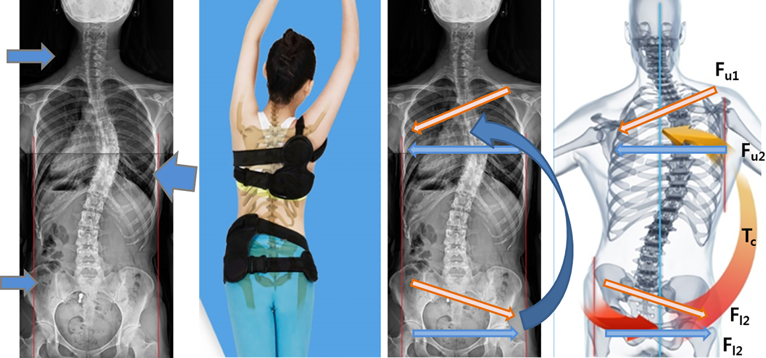 (L) Three point pressure method; (R) Counter compensation method: Two forces Fu1 and Fu2 in the upper area are applied to transverse direction of the ribs. Fl1 and Fl2 in the pelvis are reaction forces required to obtain equilibrium in the body. Tc is the counter compensation torque acting via the rib cage onto the spine.