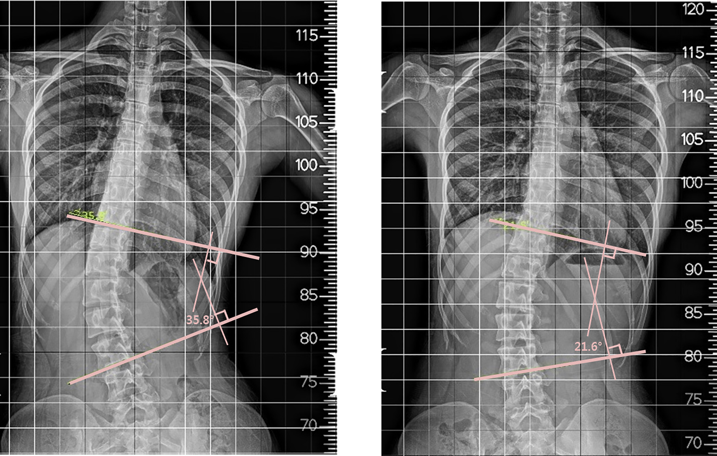 Before (L) and after (R) treatment. X-ray images of a patient wearing the new brace.