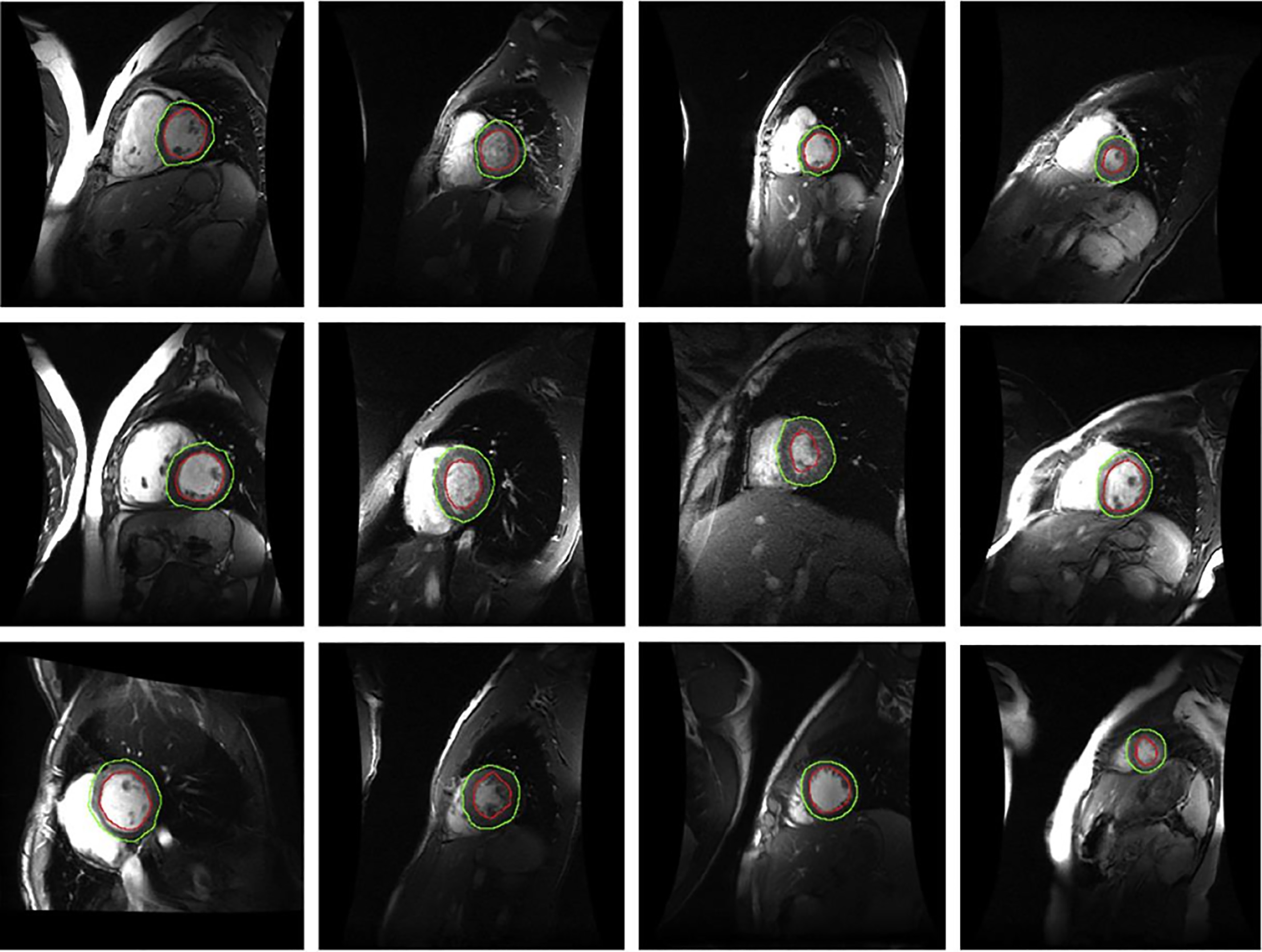 Location results of key regions found in the remaining 24 cardiac MRI images.
