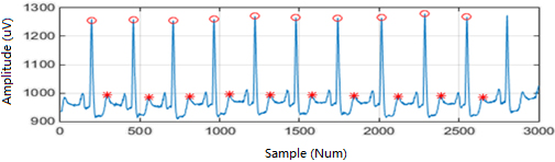 Automatic determination of the peaks of R- and T-waves by a wavelet-based method.