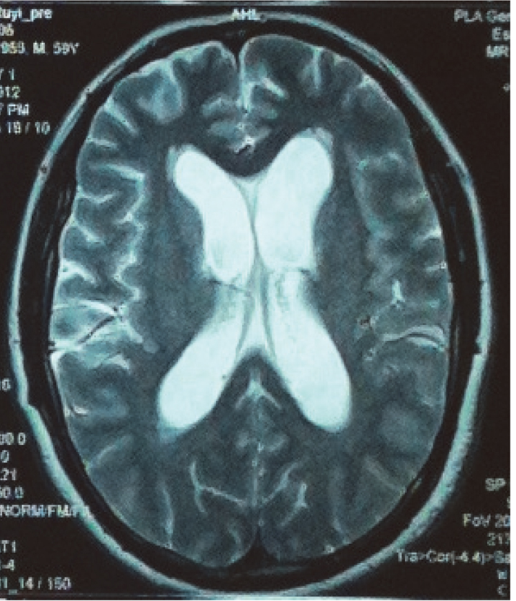 A preoperative T2-weighted magnetic resonance image from a 59-year-old male patient who was admitted to our hospital owing to ‘headache for 1 year, and aggravated headache for 1 week’. The image shows ventricular enlargement and bilateral frontal horn oedema.