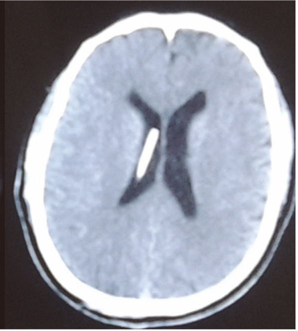 In this follow-up computed tomogrpahy image acquired 1 month postoperatively, the shunt position at the ventricular end remained accurate. Ventricular enlargement was reduced. The frontal horn oedema was no longer visible, and the patient’s headaches were alleviated.