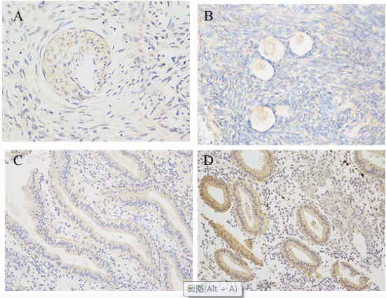Immunohistochemical analysis of AMHRII receptor in ovarian and endometrial tissues. A: control ovarian tissues (original magnification × 400); B: ovarian tissues of PCOS patients (original magnification × 400). Positive staining was detected in ovarian immature granulosa and stromal cells; C: control endometrial tissues (original magnification × 200); D: endometrial tissues of PCOS patients (original magnification × 200). Positive expression was found in the stroma and glandular epithelium cells, and the expression was more obvious in the cytoplasm of glandular epithelium.