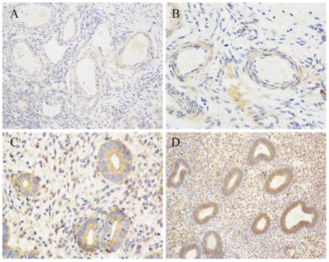 Immunohistochemical analysis of INSR receptor in ovarian and endometrial tissues. A: control ovarian tissues (original magnification × 400); B: ovarian tissues of PCOS patients (original magnification × 400). Positive staining was detected in ovarian stromal and vascular epithelium cells; C: control endometrial tissues (original magnification × 200); D: endometrial tissues of PCOS patients (original magnification × 200). Strong positive expression was found in proliferative endometrium and stroma cells.
