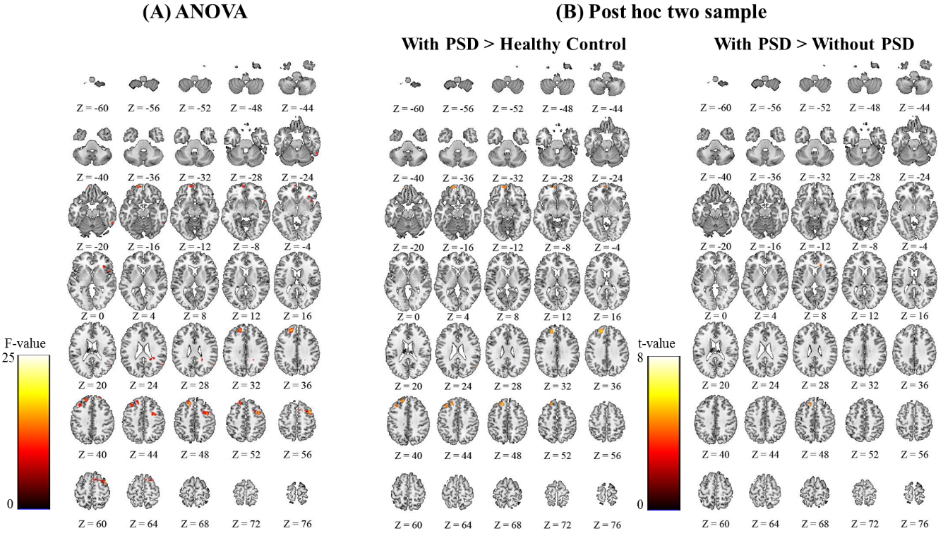 Significant functional connectivity differences at the whole brain level were revealed by ANOVA and post-hoc two sample test. The SPM{F}s and SPM{t}s with a Family Wise Error (FWE)-corrected threshold of P< 0.001 for multiple comparisons.