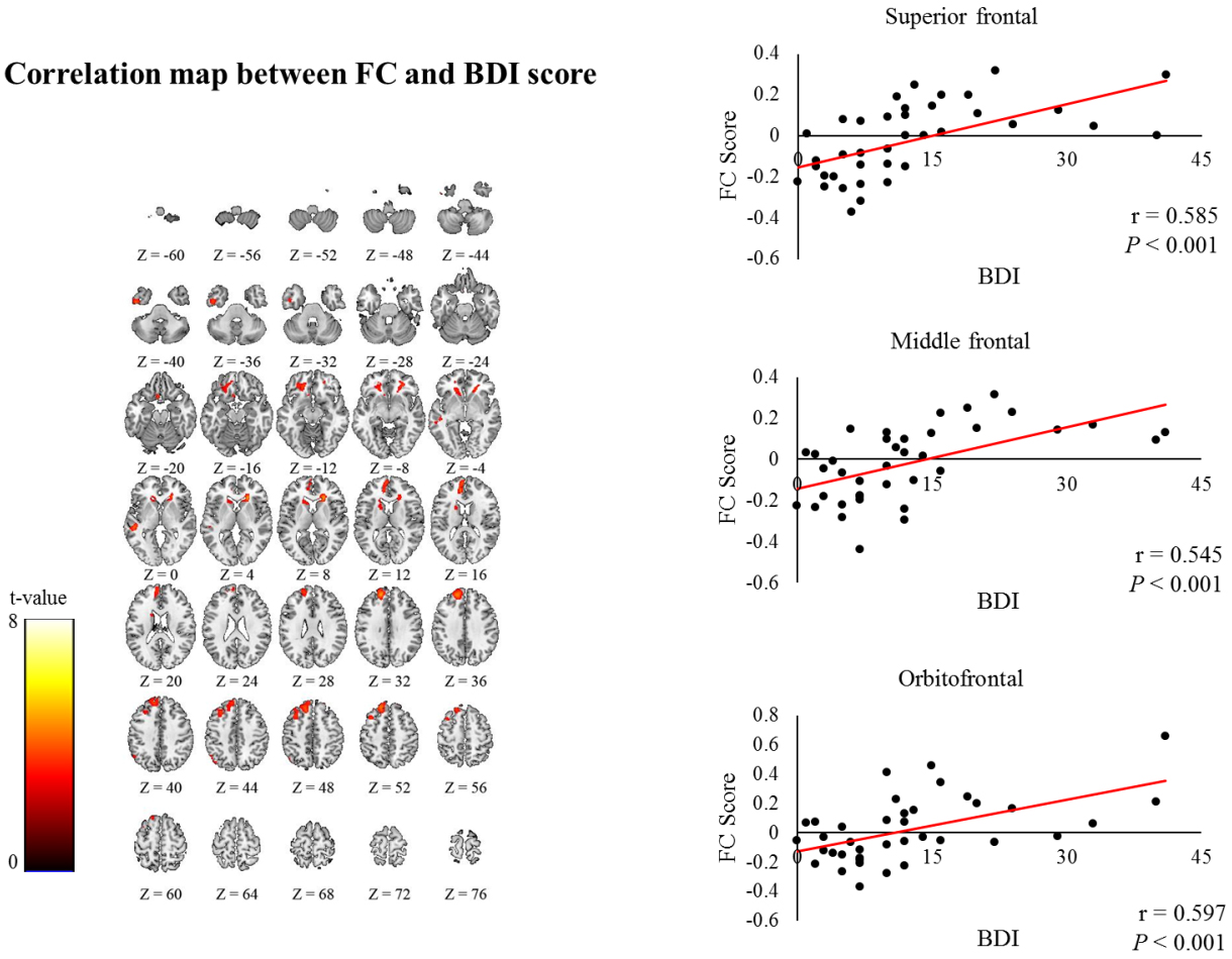 Correlation map showed that FC scores in the superior frontal, middle frontal, and orbitofrontal regions in the non-affected hemisphere strongly correlates with BDI-II scores.