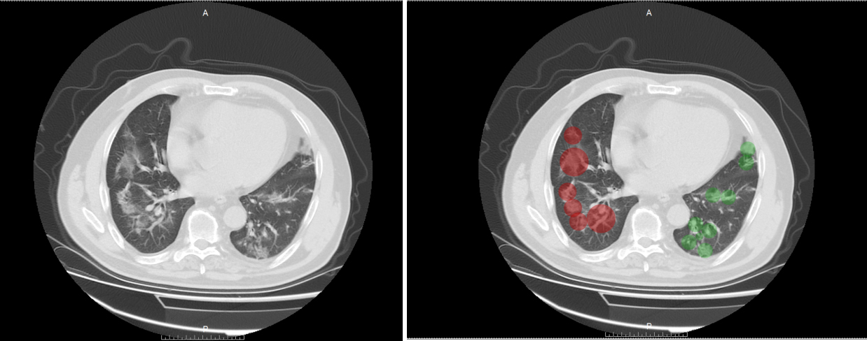 CT visual score of severe COVID-19 pneumonia.