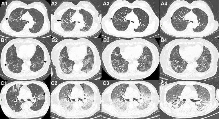 The CT images of three clinic types of patients at four stages. Shown in A1–A4 (Stage 1–Stage 4) are corresponding slices of a patient with mild symptoms (58 years, male). Shown in B1–B4 (Stage 1–Stage 4) are corresponding slices of a survivor with severe symptoms (82 years, female). Shown in C1–C4 (Stage 1–Stage 4) are corresponding slices of a non-survivor (70 years, male). The infection volume was obviously increasing in Stage-2 (8–15 days since symptom onset) in the three patients.