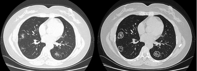A woman aged 47 years presented with a 7-day history of fever, cough, and sputum. CT imaging revealed scattered pure ground glass opacities (GGOs) and GGOs with fine grid in the bilateral lobes. Some small GGOs were missed by junior radiologists but were detected by the AI scoring system (b).