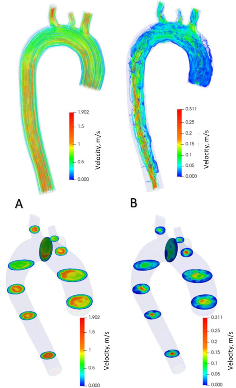 Distribution of blood flow velocities in healthy aorta.