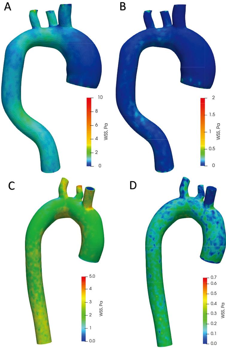 Aortic wall shear stress distributing during systole and diastole phases.