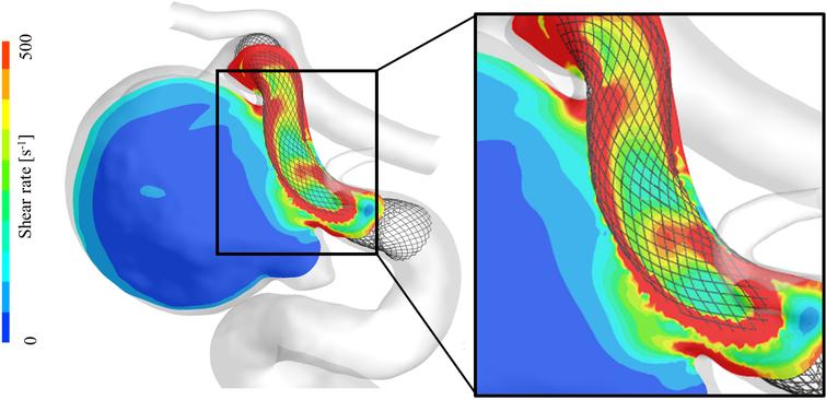 A color contour map of shear rate for an illustrative case (Case A). The shear rate value is considerably higher in the vicinity of the FD stent mesh (marked by a square).