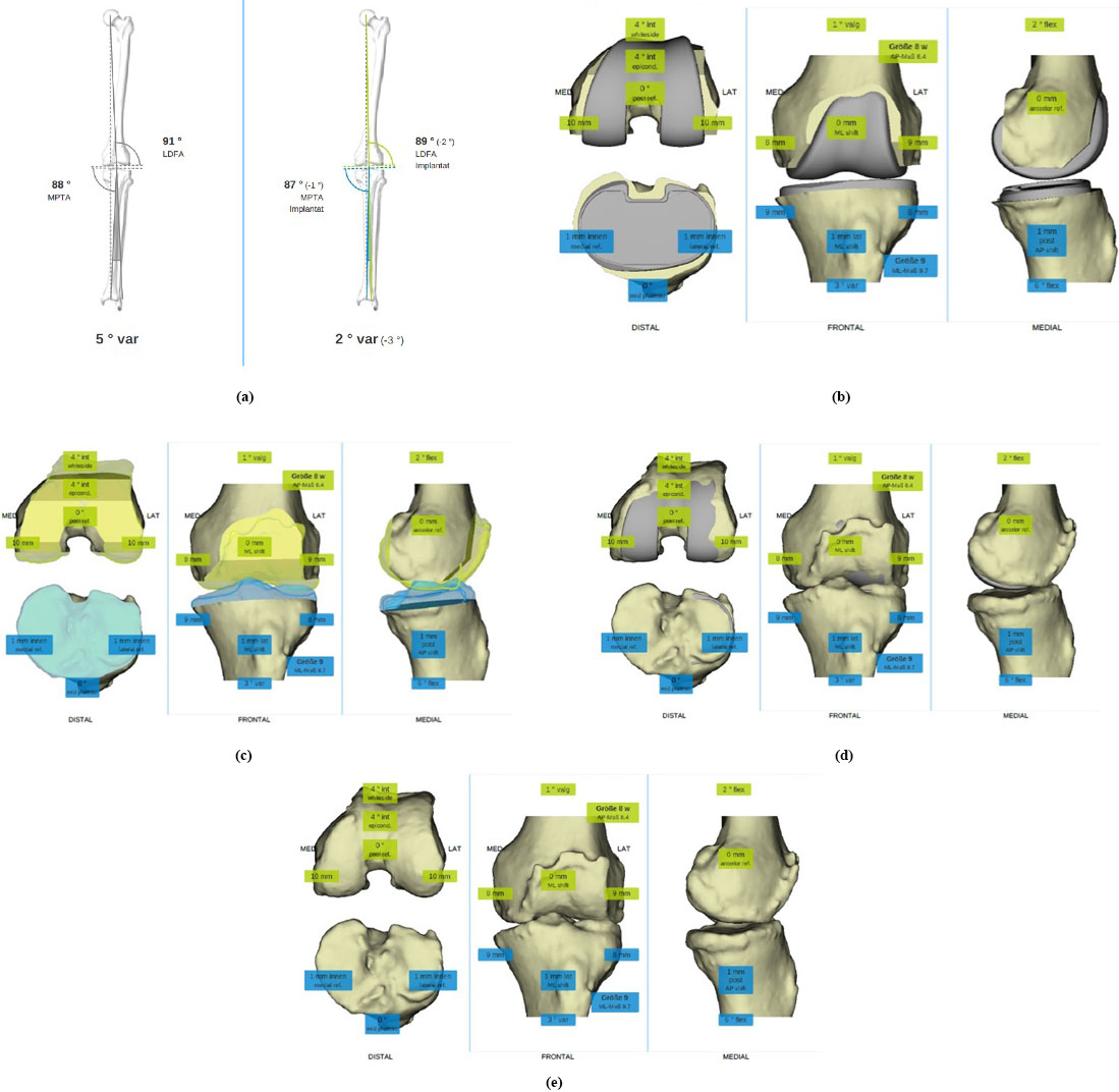 Visualisation of the preoperative (left) and the planned hip-knee-ankle (HKA) with the relevant pre- and postoperative angles (a). Three-dimensional simulation of the planned implant position with relevant angles, implant sizes and bone cuts (b). The knee with resected bone (c), the projection of the implant on the unresected bone (d) and the preoperative knee with the relevant angles and implant sizes are also visualised. 