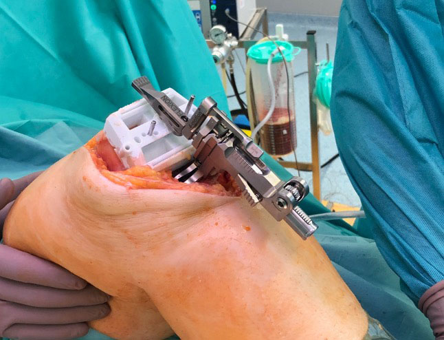 A laminar tensioner device (ARTIQO GmbH) is inserted, fixed to the femoral cut guide and spread by hand to assess the extension gap. 