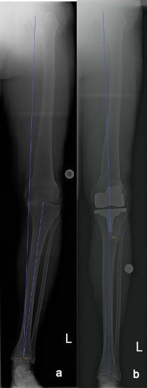 The pre- and postoperative full leg weight-bearing AP radiographs show the resulting correction of the hip-knee-ankle and the anatomically aligned implants. 