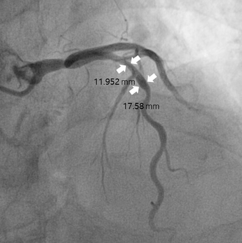 Stenosis measurement of blood vessels in ICA images.
