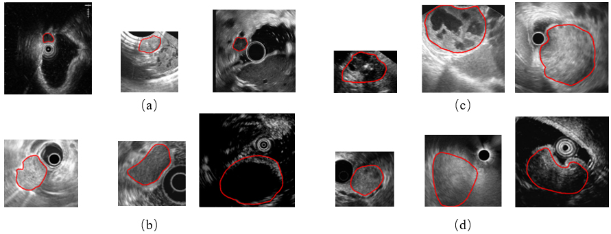 Example images of four GISTs categories. (a) The very low risk, (b) the low risk, (c) the moderate risk, and (d) the high risk. The red line indicates tumor contours.