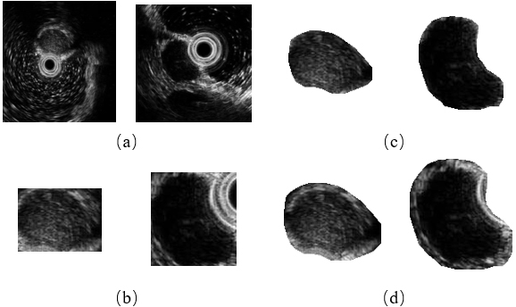 The comparison of different ROI extraction methods. (a) Original image, (b) cropping a patch using the original mask, (c) cropping a patch using the original mask and multiplying with it, and (d) cropping a patch using the dilated mask and multiplying with it (our proposed method).